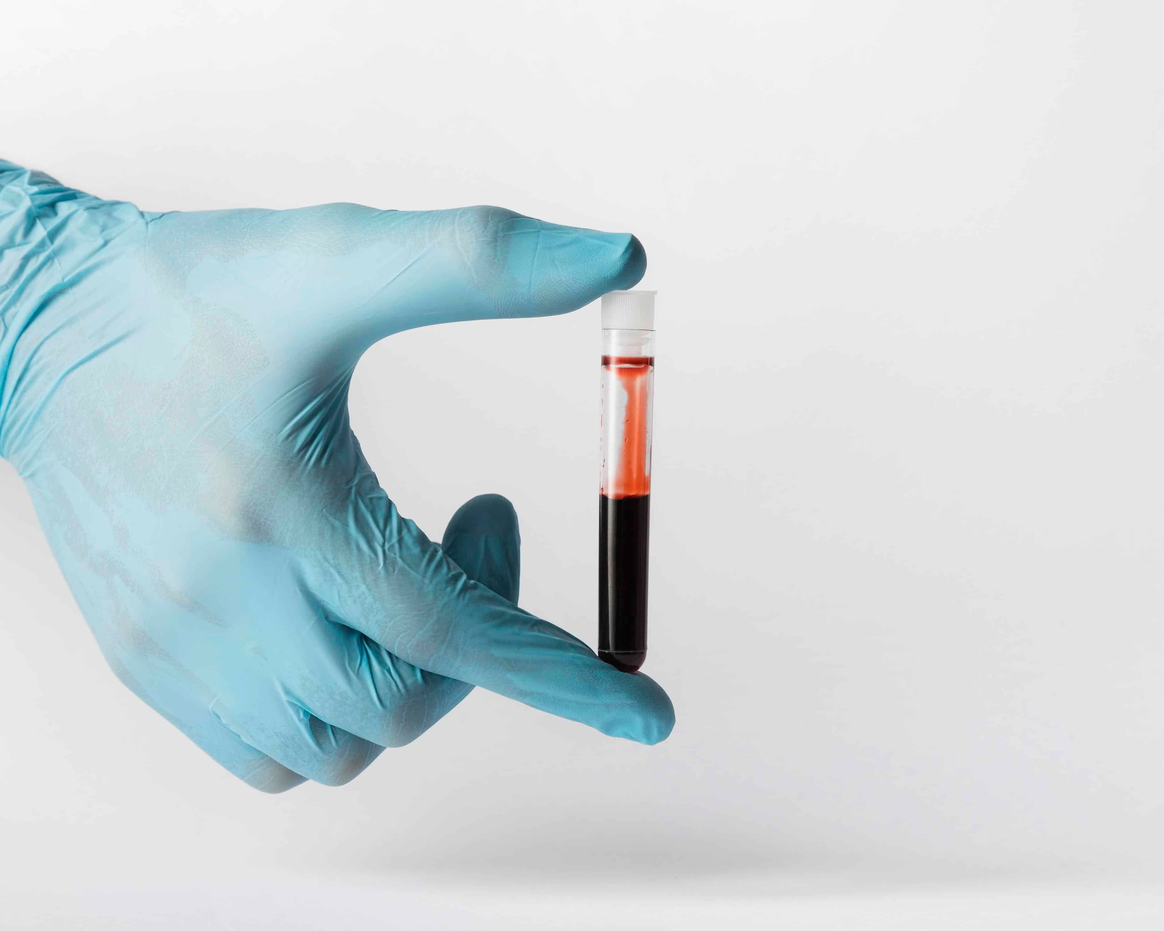 Dramatic Effects of High Blood Sugar on Exercise